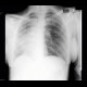 Agenesis of lung lobe: X-ray - Plain radiograph